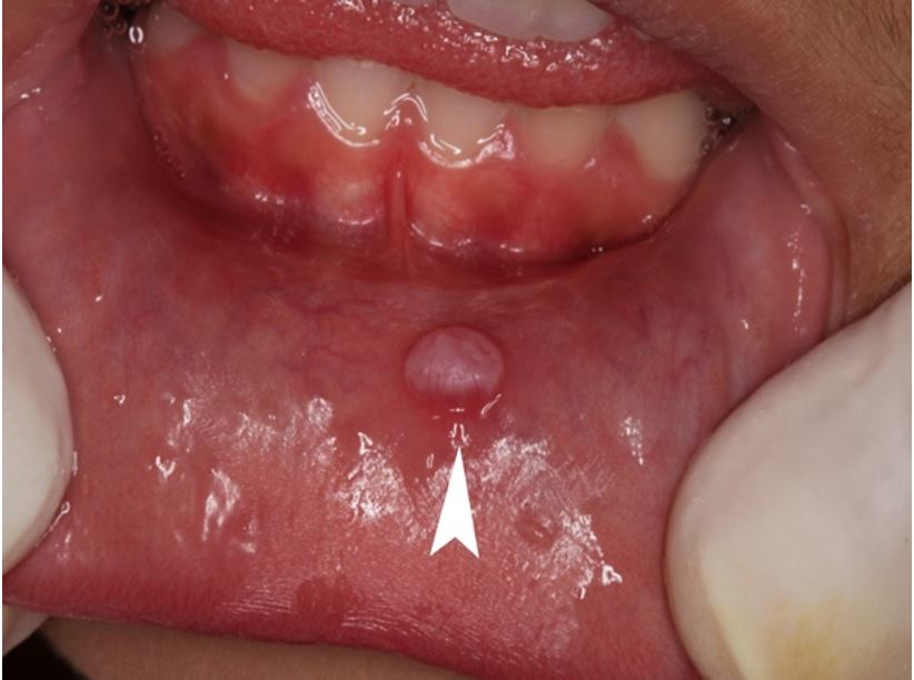 schwannoma-of-the-lower-lip-mimicking-a-mucocele-in-children-autopsy